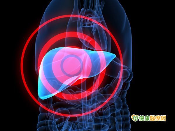 小心「脂肪肝」是肝硬化及肝癌的前奏