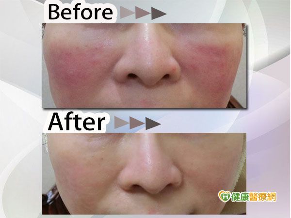 酒糟膚反覆發作？　醫籲禁用類固醇！