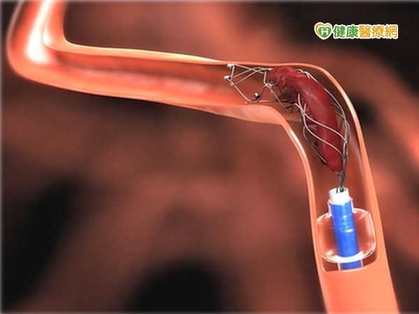 微導管動脈取栓術　中風6小時都有效