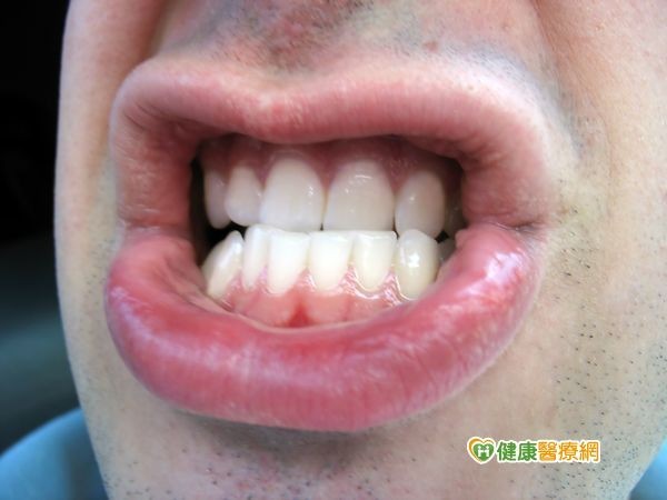 拉曼光譜偵測　口腔癌手術更精確