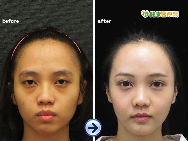 脂肪是冤家？　自體脂肪移植讓您愛上他！