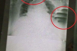阿嬤突然心律不整、喘不過氣，X光照出「2隻手掐脖」，醫師證實真有其事！