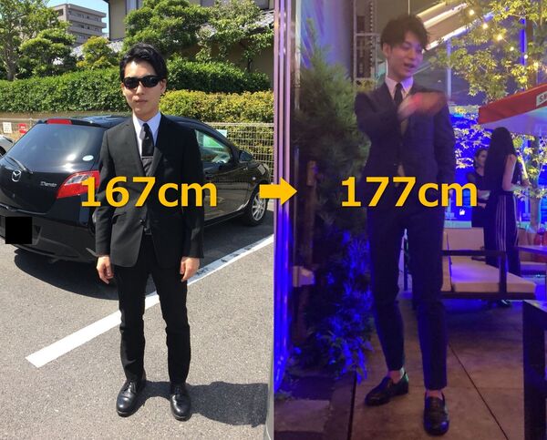 167太矮！日本男醫師忍痛「斷腿增高」成功長高10公分　術後照曝光