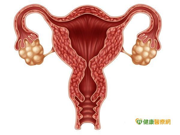 30多歲就子宮脫垂　體質惹的禍！