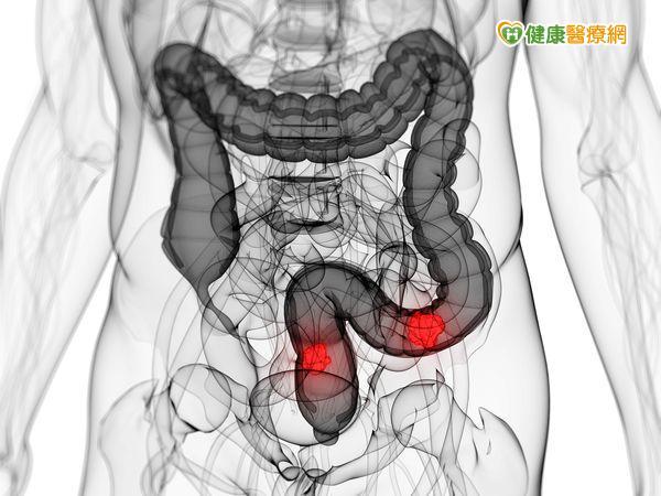 標靶胜肽聯合療法　腸癌治療露曙光
