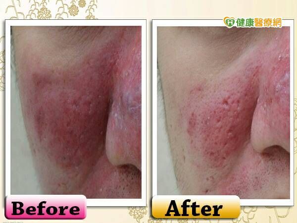 受夠了擦類固醇嗎？　『過敏性皮膚』新選擇