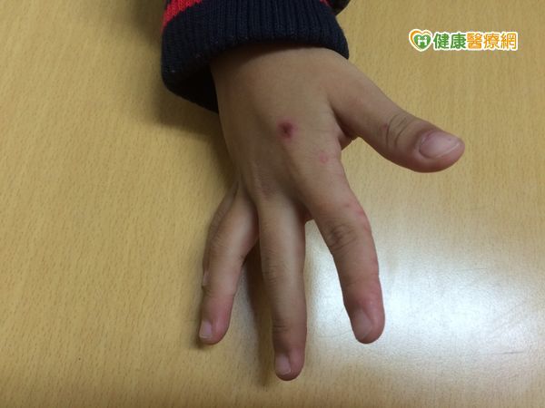 腸胃炎和腸病毒分不清　病症治療皆不同