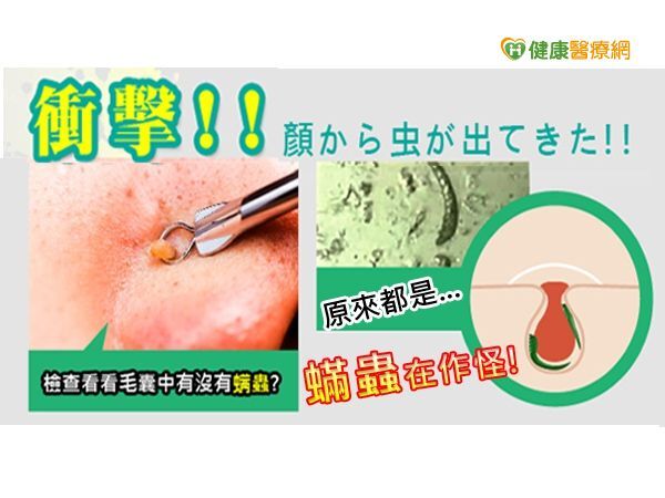 蟲蟲危肌！　「蟎」臉橫行痘痘粉刺治不好