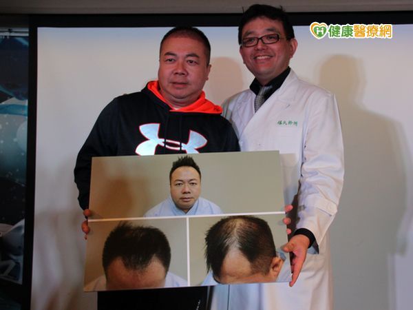 搶救禿頭危機　董哥植髮3600株