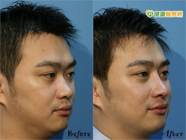 客製化鼻整形　讓你變身韓國帥氣歐巴