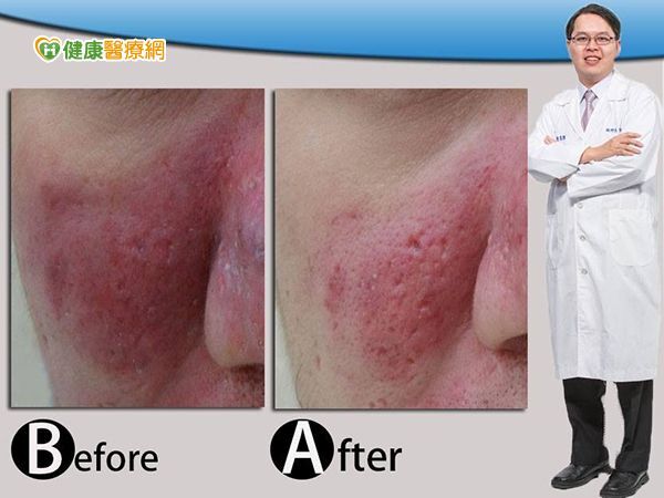 臉紅紅+肌膚敏感　告別酒糟性皮膚炎有新法