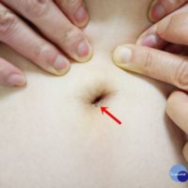 「迷你單孔腹腔鏡 」精品手術　輕鬆切除膽囊息肉