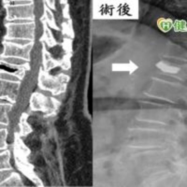 老嫗彎腰「啪」一聲骨折！　壓迫性骨折只能灌漿嗎？