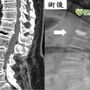 老嫗彎腰「啪」一聲骨折！　壓迫性骨折只能灌漿嗎？