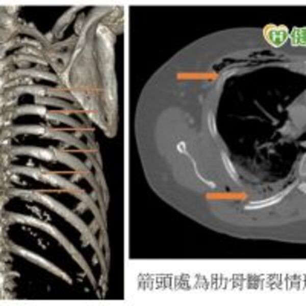 阿茲海默婦跌斷十二根肋骨　靠「鈦合金骨板」重新撐胸