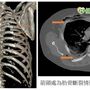 阿茲海默婦跌斷十二根肋骨　靠「鈦合金骨板」重新撐胸