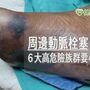 ６大周邊動脈栓塞高危險族群　輕忽下肢痠麻、皮膚變色恐截肢