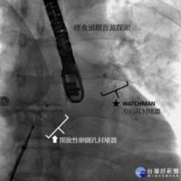 「封堵」中風血塊　台大新竹分院施以雙重保護