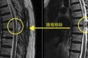 下肢麻木不一定是腰椎退化　醫師：小心脊椎腫瘤