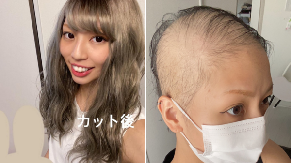 日本正妹接種莫德納後狂掉髮！1個月後「幾乎全禿」她樂觀曝光整過程