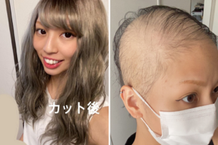 日本正妹接種莫德納後狂掉髮！1個月後「幾乎全禿」她樂觀曝光整過程