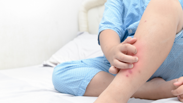 皮膚紅腫發紫！5歲孩子被蚊子叮後不小心「抓爛傷口」差點殘疾，所幸處理及時