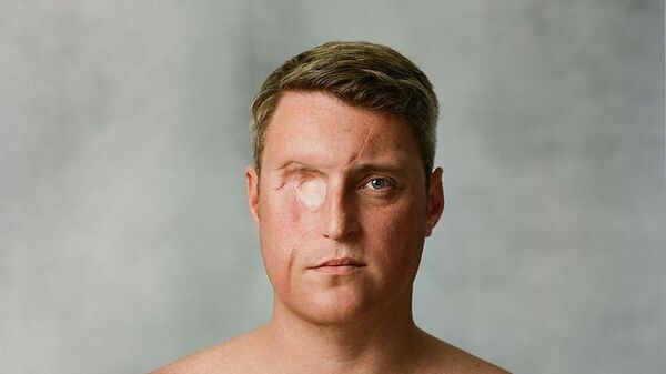 流眼淚竟是患癌征兆？男子不幸患上罕見「篩竇癌」，被迫移除右眼保住性命