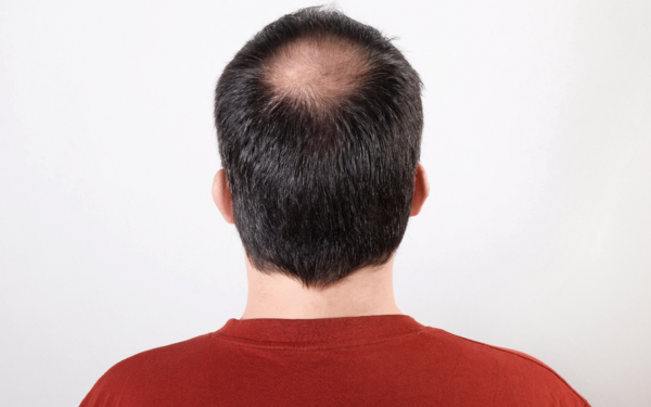 恩愛時男友突掉假髮，引來醫師幽默回覆：「愛他就幫他戴回去」並呼籲洗澡時要避免「掉髮元兇」