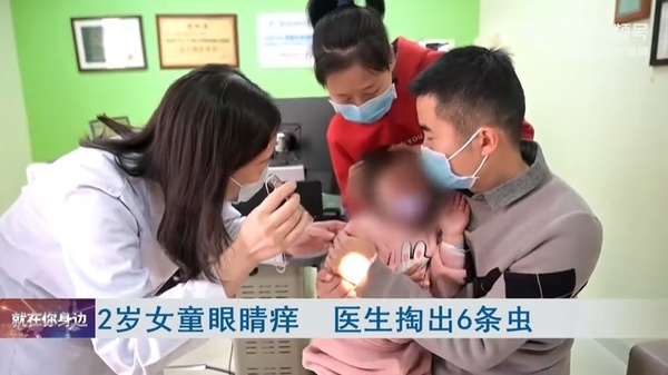 和狗狗玩沒洗手！2歲女童眼睛癢就醫「竟挑出6隻活蟲」