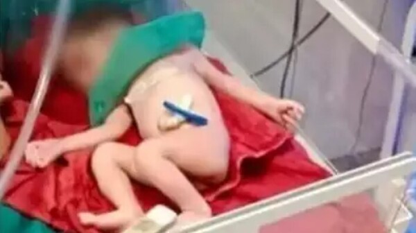 印度孕婦遭輾全身骨折！女嬰從破裂子宮出生　醫驚：真的是奇蹟