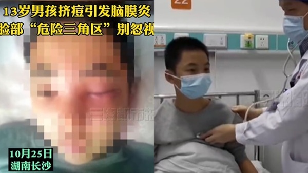 擠痘痘竟釀死亡危機！13歲男孩腦膜炎　醫：臉上「這些地方」別亂碰