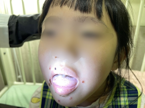 小妹妹罹患急性皰疹性齒齦口腔炎