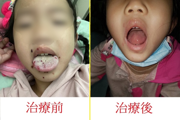 小妹妹罹患急性皰疹性齒齦口腔炎