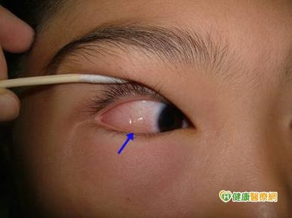 眼睛過敏狂揉　竟使眼白水腫如荔枝！