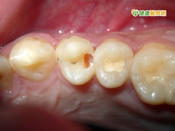 女罹下陷型齲齒　牙齒敏感痠痛竟全蛀空