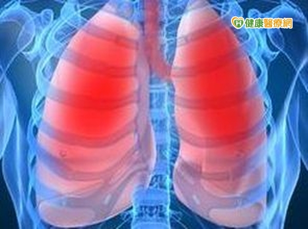 特發性肺纖維化　急性惡化死亡率高達九成