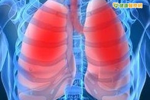 特發性肺纖維化　急性惡化死亡率高達九成