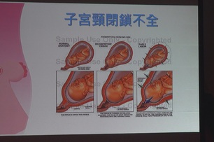 子宮肌腺症難「好孕」　整合治療圓夢當媽