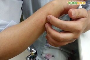女大生染麻疹　今年本土首例個案