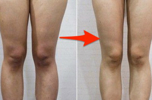肌肉腿有救了！她做了一個月…蘿蔔腿不見了！腿變得又細又直…姐妹們都羨慕死了！