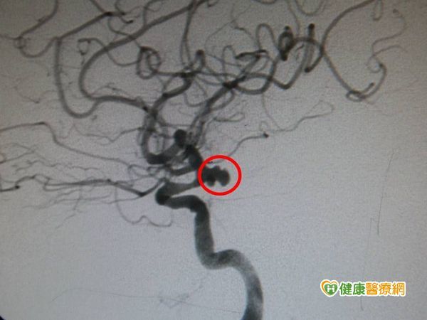 突然劇烈頭痛　竟是腦動脈瘤破裂