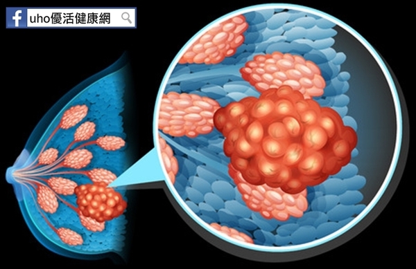 乳房脹痛　良性囊腫竟癌變！