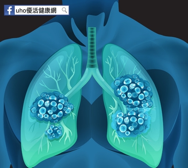 檢查肺癌　半年1年X光最佳