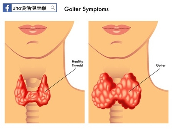 60年不敢開刀　脖子腫大如蛋！