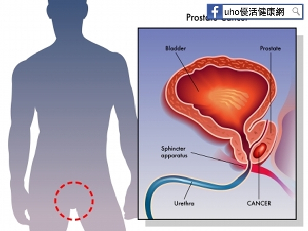 防攝護腺癌　40歲起應每年指診