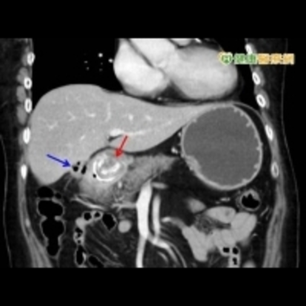 膽囊才多大？　竟然有人膽結石4公分