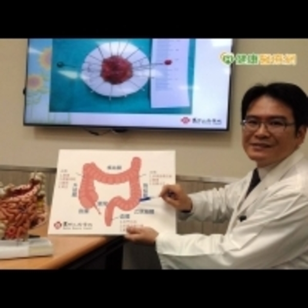 扁平狀息肉癌變機率高　早期大腸癌治療無傷口