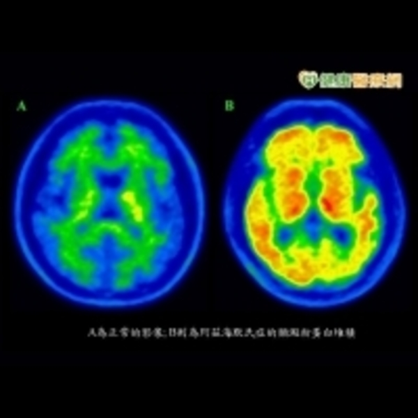 透過新型試劑　加速確診失智原因