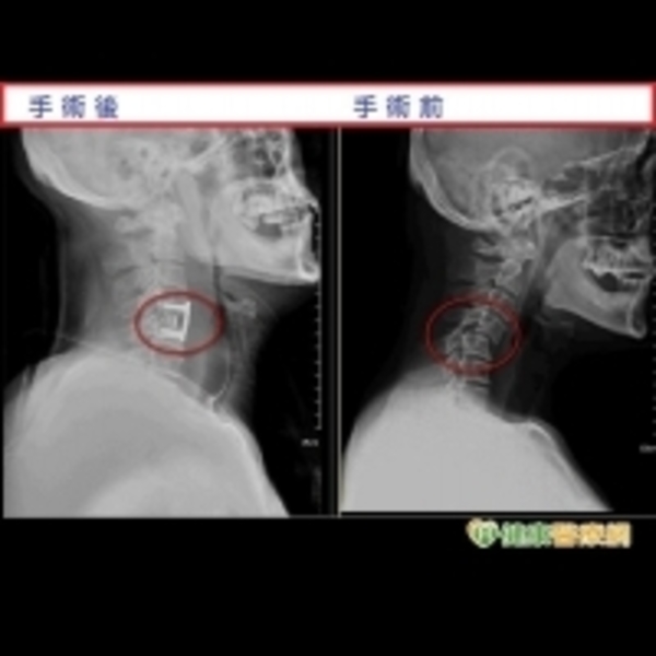 跌倒後頸部痠痛　竟是頸椎脫位惹禍