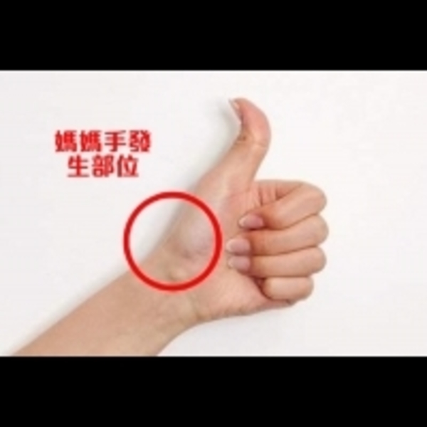 翹起拇指比讚的手勢時會更痛！如何預防媽媽手的發生，「這些運動」可以試試看...